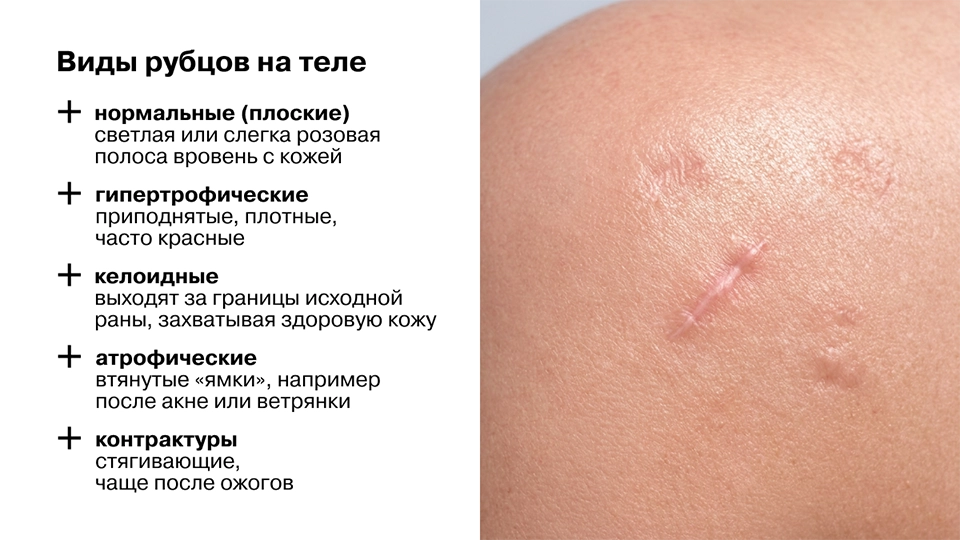 Виды рубцов на теле