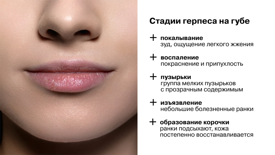 Стадии герпеса на губе
