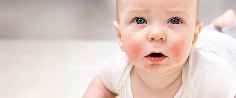 Атопический дерматит: распознать и обезвредить